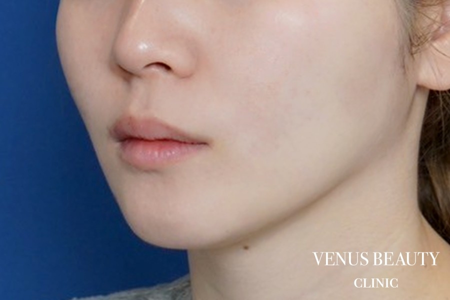 ダブロゴールド 施術後