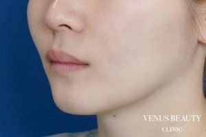 ダブロゴールド 施術前