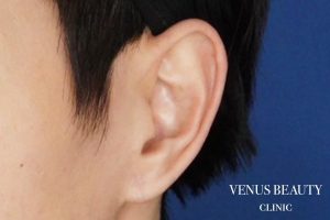 ピアス穴修正 施術後