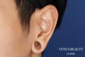 ピアス穴修正 施術前