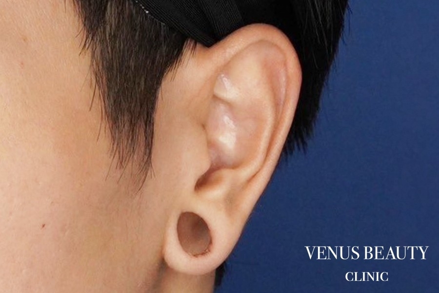 ピアス穴修正 施術前