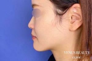 カベリン 施術後