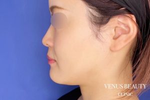 カベリン 施術前