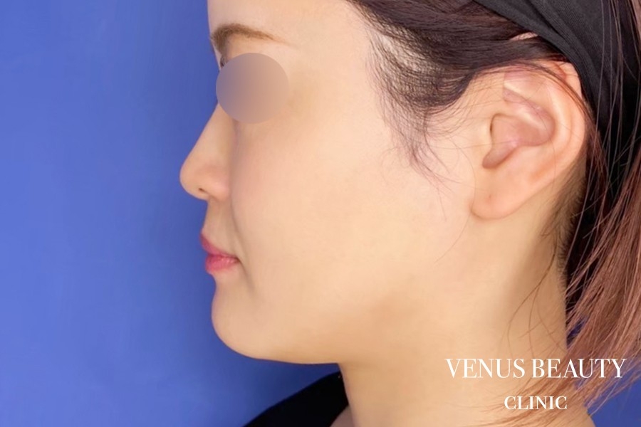 カベリン 施術前