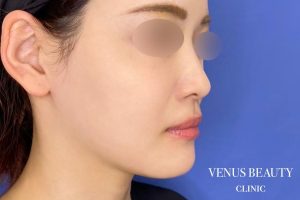 カベリン 施術後