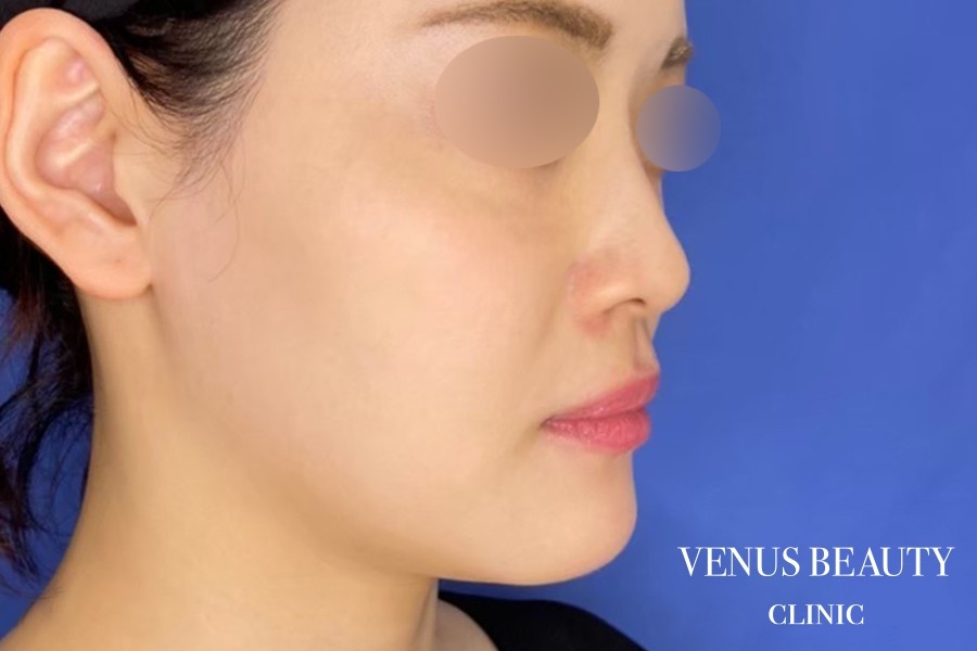 カベリン 施術前