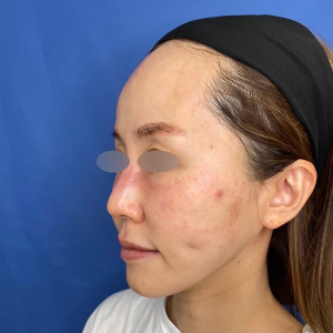 フォトフェイシャルM22(IPL) 施術前