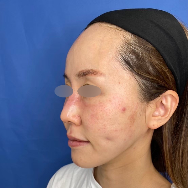 フォトフェイシャルM22（IPL） 施術前