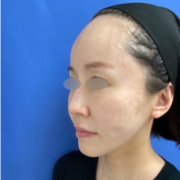 フォトフェイシャルM22（IPL） 施術後