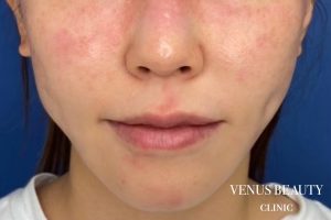 フォトフェイシャルM22(IPL) 施術前