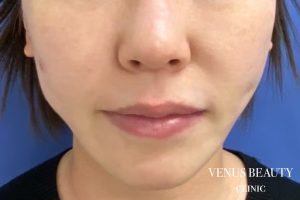 フォトフェイシャルM22(IPL) 施術後