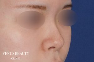 鼻中隔延長 施術前