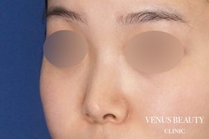 鼻尖形成 施術後