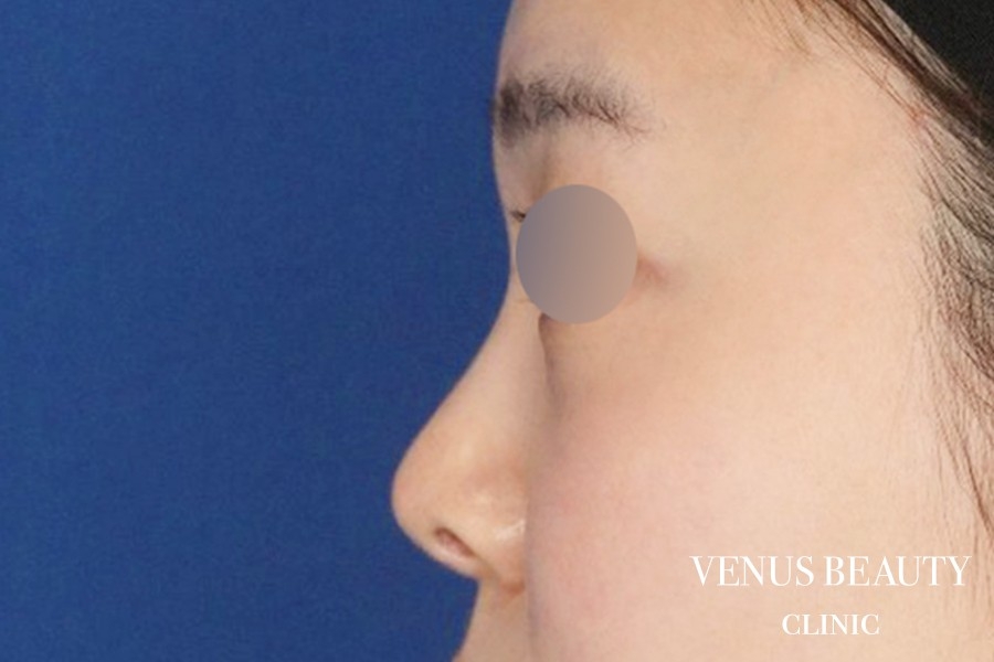 鼻尖形成 施術後