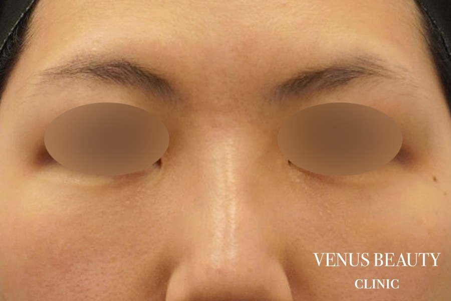 下まぶたのたるみとり 施術後