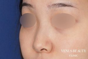 鼻尖形成 施術前