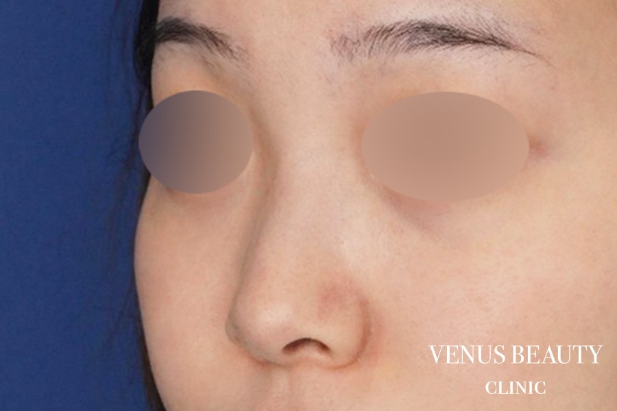 鼻尖形成 施術前