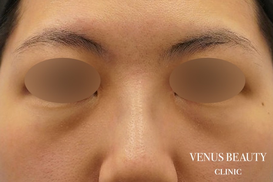 下まぶたのたるみとり 施術前