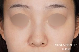 鼻尖形成 施術前