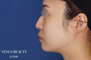 顔(頬・顎下)の脂肪吸引 施術前