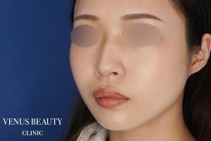 顔(頬・顎下)の脂肪吸引 施術後