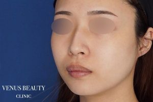 顔(頬・顎下)の脂肪吸引 施術前