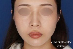 顔(頬・顎下)の脂肪吸引 施術後