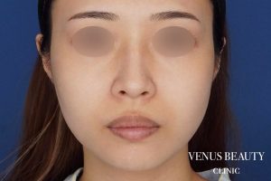 顔(頬・顎下)の脂肪吸引 施術前