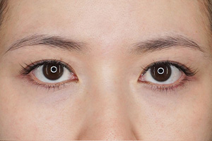 眉下切開(眉下リフト) 施術前