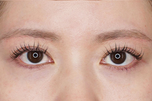 眉下切開(眉下リフト) 施術後